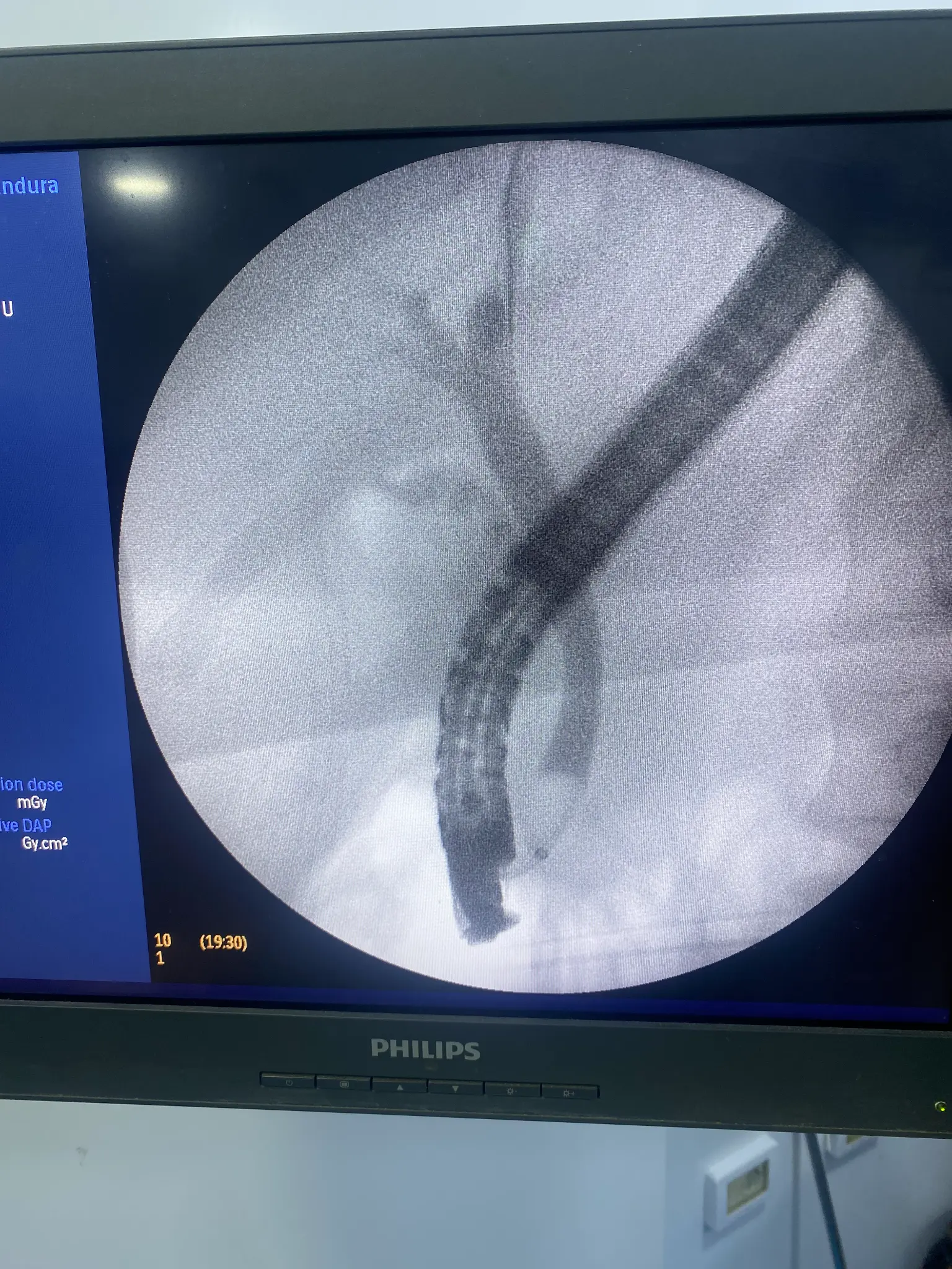 ERCP Intervention 6