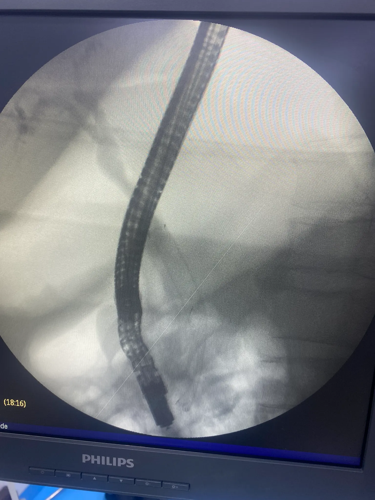 ERCP Intervention 8